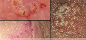 Herpes sinh dục là bệnh gì?