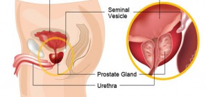 Bệnh viêm tuyến tiền liệt là gì?