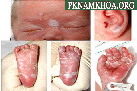 Hình ảnh bệnh giang mai ở trẻ sơ sinh